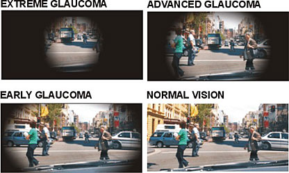 Changes in eyesight due to glaucoma